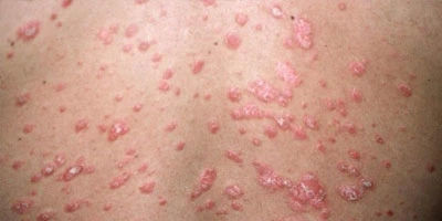 Psoriasis